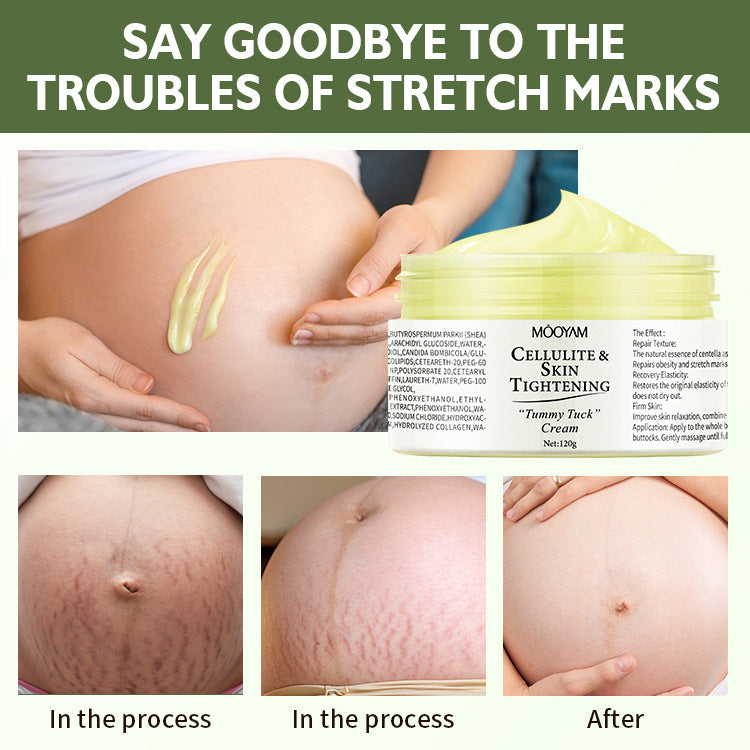 Fast-absorbing anti-stretch mark cream for smoother skin